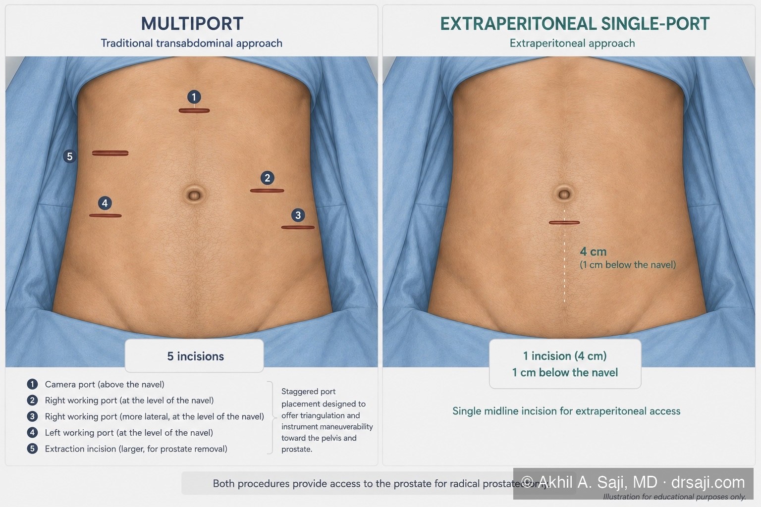 Comparison of abdominal access for robotic prostatectomy: the traditional multiport transabdominal approach uses five incisions across the abdomen, while the extraperitoneal single-port approach uses one 4 cm incision, 1 cm below the navel