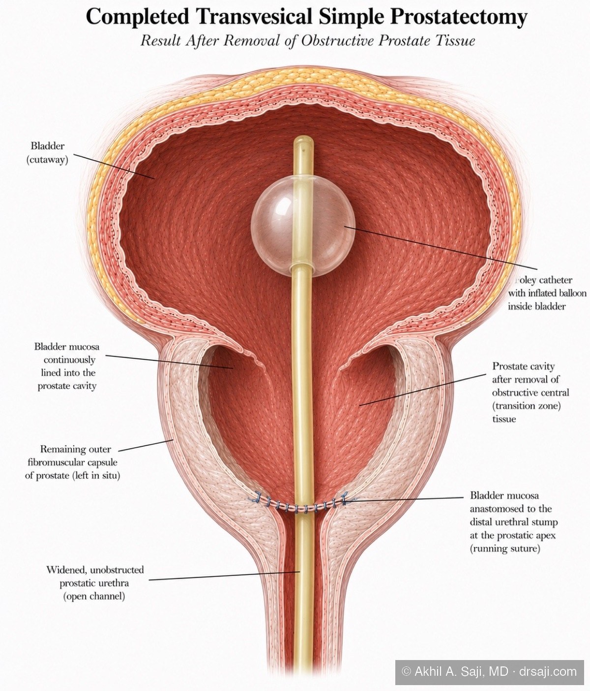 Illustration of the completed transvesical simple prostatectomy: widened open prostatic channel, bladder lining sewn to the urethra, and a Foley catheter in place while healing